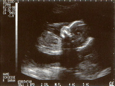 ultrasound January 10, 2000